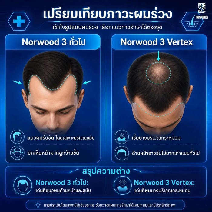 เปรียบเทียบ Norwood 3 ทั่วไปกับ Norwood 3 Vertex