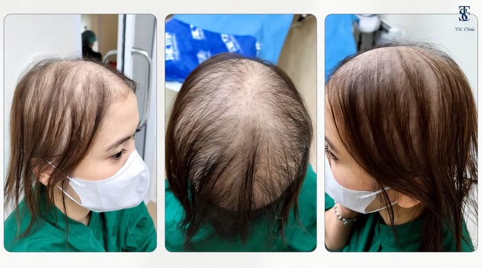 ผมบางทั่วศีรษะไม่มี Donor Area เพียงพอสำหรับปลูกผม