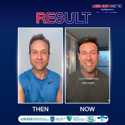 สำหรับเคส Dr.Zac Turner บริเวณ Donor Area มีกราฟต์ผมจำกัด และสภาพผมค่อนข้างบาง ขณะที่บริเวณด้านบนศีรษะต้องการความหนาแน่นเพิ่มเติม จึงต้องมีการวางแผนใช้กราฟต์อย่างแม่นยำที่สุด