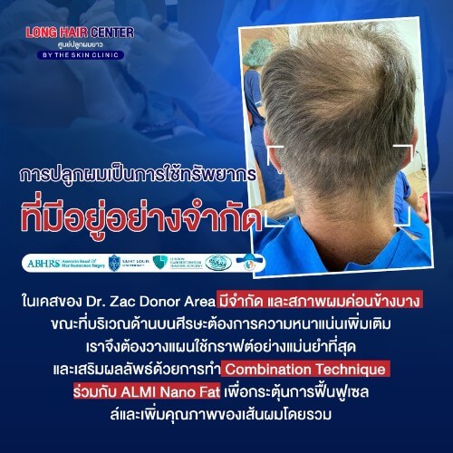 แพทย์หลายคนสามารถเรียนปลูกผมได้ในเวลาแค่ไม่กี่วันจากคอร์สอบรมระยะสั้น แต่สำหรับแพทย์ที่เข้าใจเรื่องการรักษาจริงๆ จะรู้ว่าการปลูกผมไม่ใช่แค่ “ทำให้ผมที่ปลูกขึ้น” แต่ต้องวางแผนให้เส้นผมที่มีอยู่เดิมไม่ร่วงซ้ำ