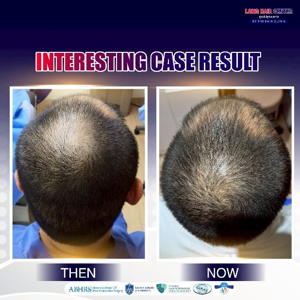 ปลูกผมแน่น, ปลูกผมที่ไหนดี, ปลูกผม FUE