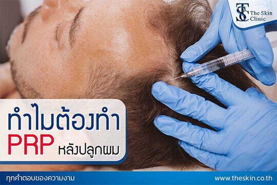 หลังการปลูกผม ทำไมต้องทำ PRP ?