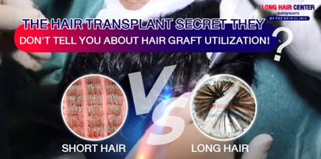 Hair Transplant Aftercare: Do You Need Minoxidil or Finasteride?