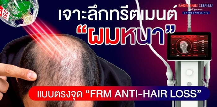 เพิ่มผมหนาโดยไม่ต้องปลูกผม ด้วยเทคนิค FRM Anti-Hair Loss