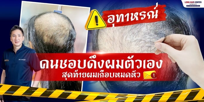หัวล้านจากโรคดึงผมตัวเอง ปลูกผมได้ไหม? รักษายังไงดี