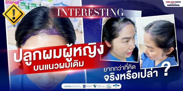 ปลูกผมผู้หญิง บนแนวผมเดิม ยากกว่าที่คิดจริงหรือเปล่า