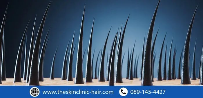 ปลูกผม ตอบทุกคำถามคาใจ