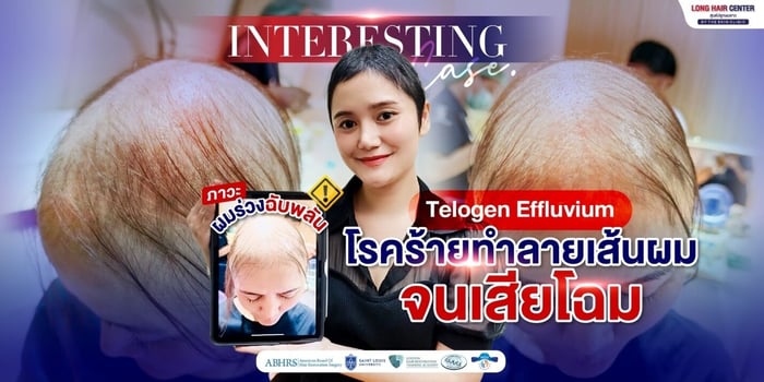 โรคผมร่วงฉับพลัน