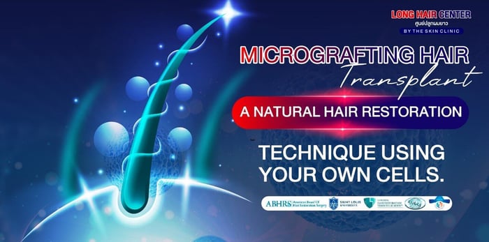 Micrografting Hair: A Natural Hair Restoration Technique Using Your Own Cells.
