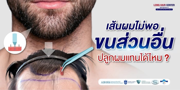 การปลูกผมโดยใช้เส้นขนบริเวณอื่นในร่างกาย ทำได้หรือไม่?