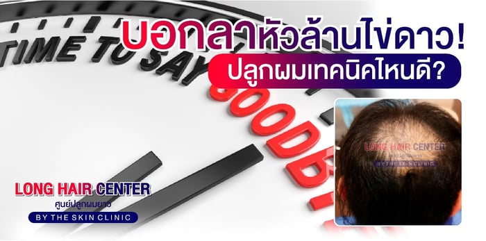 หมดกังวลเรื่องผมร่วง ผมบาง ศีรษะล้าน รักษาได้โดยไม่ต้องปลูกผม!