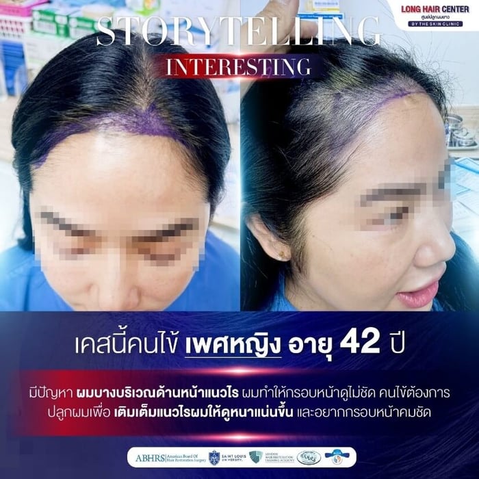 Interesting Case ปลูกผมผู้หญิง บนแนวผมเดิม