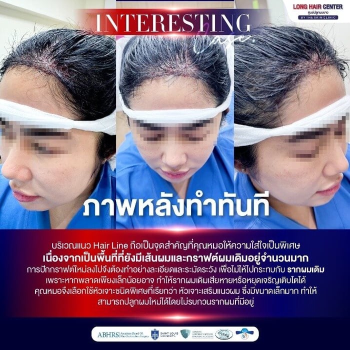 ภาพหลังทำทันที ปลูกผมผู้หญิง บริเวณแนว Hair Line