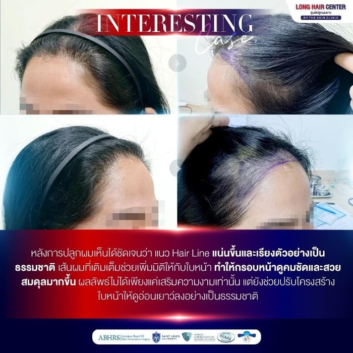 ข้อควรระวัง! ถ้าหากจะปลูกผมผู้หญิงทับแนวผมเดิม