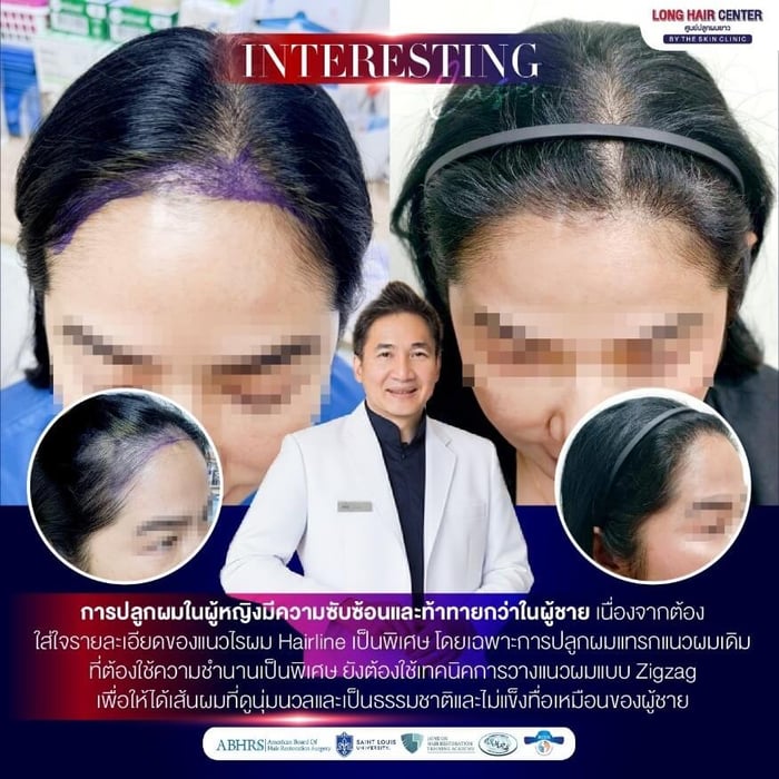 การปลูกผมผู้หญิงบริเวณ Hair Line ต้องอาศัยความละเอียด ความชำนาญ และประสบการณ์ของแพทย์ เพื่อให้ได้ทั้งความหนาแน่นที่ต้องการ และกลมกลืนกับแนวผมเดิม