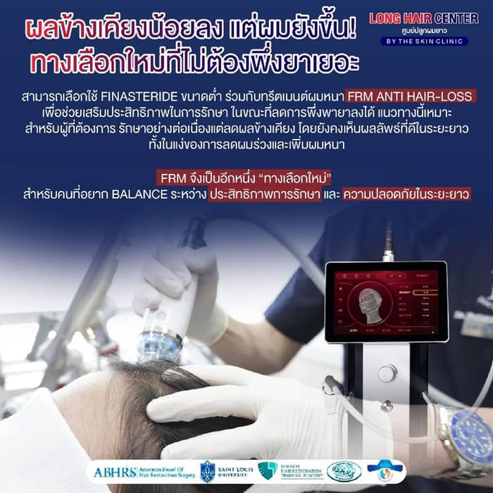อีกหนึ่งทางเลือกที่ไม่ต้องพึ่งยาเยอะ ผลข้างเคียงน้อยลง แต่ผมยังขึ้น คือ สามารถเลือกใช้ยา Finasteride ขนาดต่ำร่วมกับการทำทรีตเมนต์ฟื้นฟูผมหนาอย่าง FRM Anti Hair – Loss เพื่อช่วยเสริมประสิทธิภาพในการรักษาผมบาง