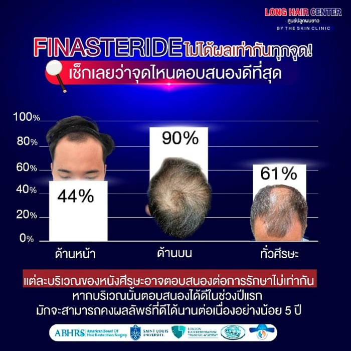 การใช้ Finasteride ไม่ได้ผลเท่ากันทุกบริเวณ แต่ละบริเวณของหนังศีรษะอาจตอบสนองต่อการรักษาไม่เท่ากัน หากบริเวณนั้นตอบสนองได้ดีในช่วงปีแรก มักจะสามารถคงผลลัพธ์ที่ดีได้นานต่อเนื่องอย่างน้อย 5 ปีการใช้ Finasteride ไม่ได้ผลเท่ากันทุกบริเวณ แต่ละบริเวณของหนังศีรษะอาจตอบสนองต่อการรักษาไม่เท่ากัน หากบริเวณนั้นตอบสนองได้ดีในช่วงปีแรก มักจะสามารถคงผลลัพธ์ที่ดีได้นานต่อเนื่องอย่างน้อย 5 ปี