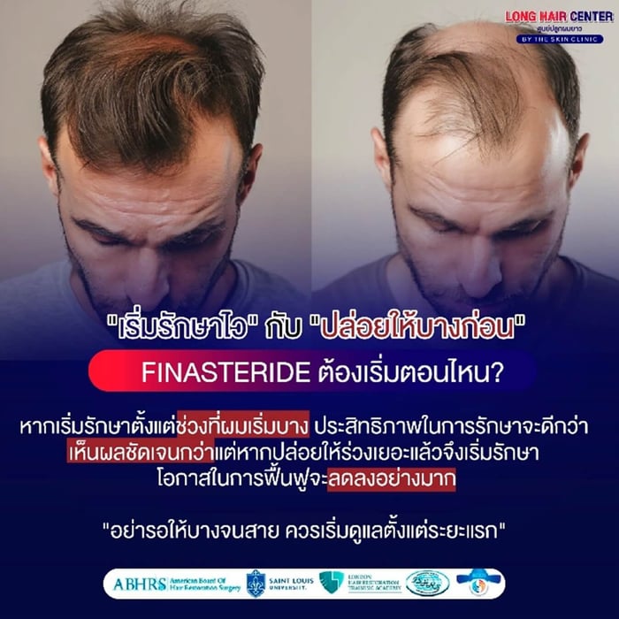 การรักษาผมบาง “อย่ารอให้สาย ควรเริ่มดูแลตั้งแต่ระยะแรก” หากตัดสินใจใช้ ยา Finasteride รักษาตั้งแต่ช่วงที่ผมเริ่มบาง ประสิทธิภาพในการรักษาจะดีกว่า เห็นผลชัดเจนกว่า