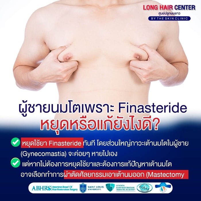 หากพบภาวะเต้านมโตในผู้ชาย (Gynecomastia) แนะนำให้หยุดใช้ยา Finasteride ทันที โดยทั่วไปอาการจะค่อยๆ ดีขึ้นเอง แต่หากไม่ต้องการหยุดยา