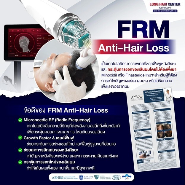 มีการใช้เทคนิค FRM Anti-Hair Loss เป็นทางเลือกในการรักษาคนไข้ที่ไม่อยากทานยา ไม่อยากปลูกผม และไม่ตอบสนองต่อการรักษา เช่น การกินยาหรือใช้ยาในการรักษาอาการผมร่วงมาแล้วระยะหนึ่ง