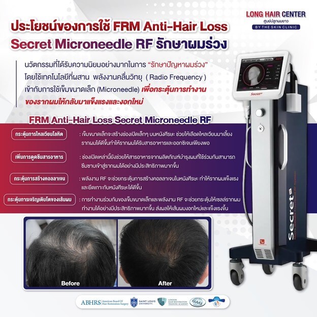 ยาที่ใช้ในการรักษาผมร่วงคือ Minoxidil และ Finasteride ที่ต้องใช้ตลอดชีวิต หยุดเมื่อไหร่ ผมร่วงเมื่อนั้น! ซึ่งเทคนิค FRM Anti-Hair Loss เป็นการรักษาที่ช่วยให้เส้นผมงอกใหม่ตามธรรมชาติ โดยลดการพึ่งยา