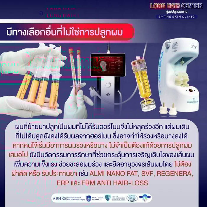 หลายคนเข้าใจผิดว่าการปลูกผมแบบ FRM Anti-Hair Loss เป็น Single Treatment ที่ทำครั้งเดียวแล้วเห็นผลระยะยาว แต่ในความเป็นจริง ผลลัพธ์ของการรักษาขึ้นอยู่กับสภาพเส้นผม และปัญหาผมร่วงของแต่ละบุคคล