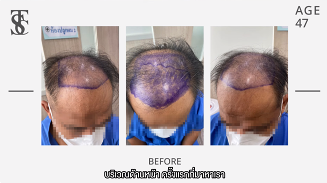 ปลูกผมที่ไหนดี, คลินิกปลูกผม