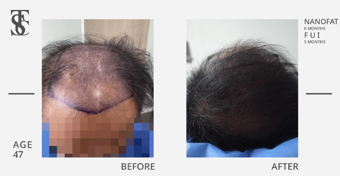 ศัลยกรรมปลูกผม, ราคา ปลูกผม