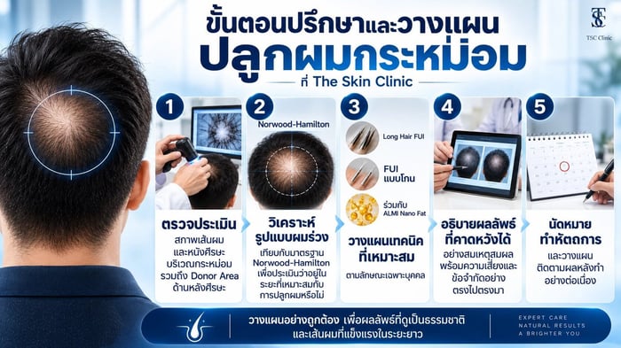 แพทย์ประเมินและวางแผนปลูกผมกระหม่อมเฉพาะบุคคลที่ The Skin Clinic