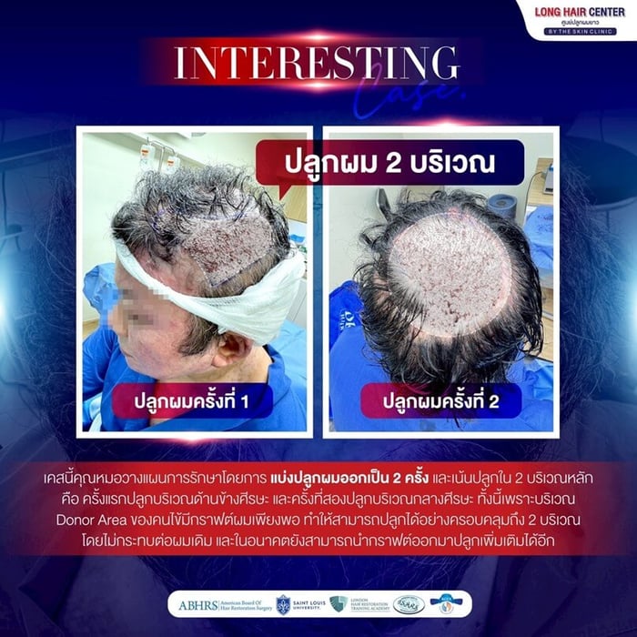 ด้วยกราฟต์ผมที่เพียงพอ ทำให้สามารถปลูกผมได้อย่างครอบคลุมถึง 2 บริเวณ โดยไม่กระทบต่อผมเดิม และในอนาคตยังสามารถนำกราฟต์ออกมาปลูกเพิ่มเติมได้อีก