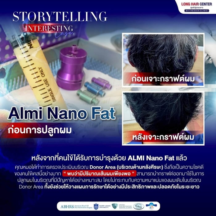 ALMI Nano Fat เป็นเทคนิคในการนำไขมันของตัวเองมาใช้ในการรักษา โดยทำการสกัดไขมันจากต้นขาหรือสะโพก แล้วนำมาผ่านกระบวนการเพื่อให้ได้ไขมันขนาดนาโนแฟต อุดมไปด้วย Growth Factor ที่ช่วยบำรุงเส้นผม เป็นการเพิ่มชั้นไขมันใต้หนังศีรษะให้หนาขึ้น ทำให้เลือดมาเลี้ยงบริเวณรากผมมากขึ้น พร้อมทั้งกระตุ้นการสร้างเส้นผมใหม่ที่แข็งแรงกว่าเดิม 