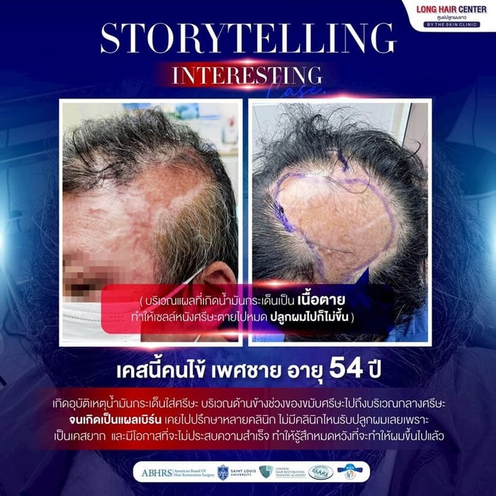 คนไข้เพศชาย อายุ 54 ปี ที่ประสบอุบัติเหตุถูกน้ำมันลวกศีรษะบริเวณขมับไปจนถึงกลางศีรษะ ทำให้เซลล์หนังศีรษะตายทั้งหมด เส้นผมไม่สามารถงอกขึ้นใหม่ได้ เคสนี้คนไข้เคยปรึกษามาหลายคลินิก แต่ไม่มีคลินิกไหนรับปลูกผมให้