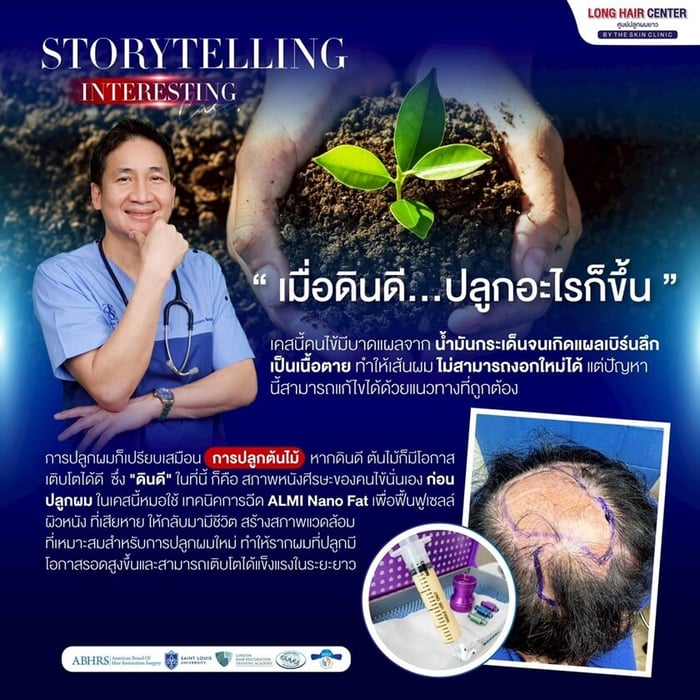 ทางเลือกสำหรับผู้ที่กังวลผลข้างเคียงจากยา เทคนิค ALMI Nano Fat ช่วยชะลอการร่วงของเส้นผมเดิม และเสริมประสิทธิภาพการปลูกผมโดยไม่จำเป็นต้องรับประทานยา