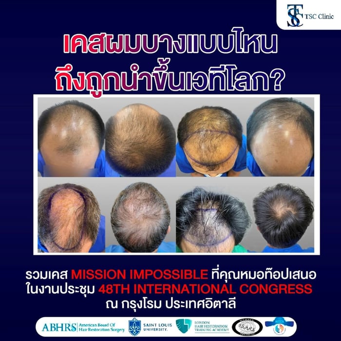 หัวล้าน