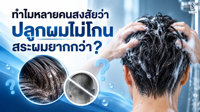 ปลูกผมใช้เวลานานไหม? ไขข้อสงสัยที่คนอยากปลูกผมต้องรู้