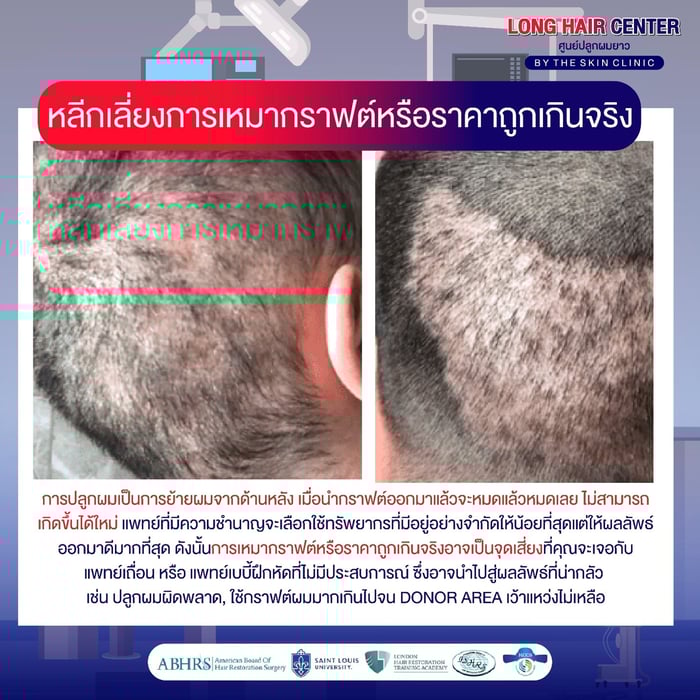 ปลูกผมแบบเหมากราฟต์ คืออะไร?