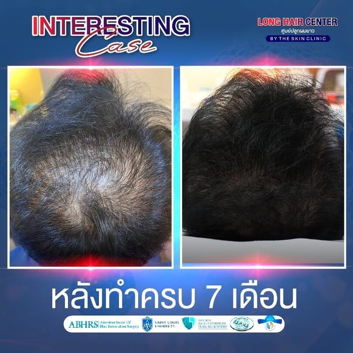 คลินิกปลูกผม, ปลูกผม ราคาเท่าไหร่