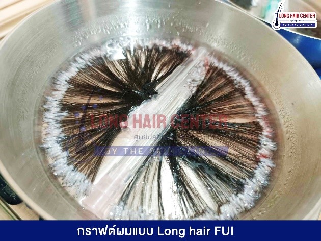 กราฟต์ผมแบบ Long Hair: กราฟต์ผมที่เจาะออกมาจะมีลักษณะยาวเหมือนเส้นผมปกติของเรา เมื่อเจาะกราฟต์ออกมาแล้ว ทีมแพทย์จะนำกราฟต์ผมที่ได้ไปปลูกยังบริเวณที่ต้องการ สามารถเห็นแนวผมใหม่ที่หนาแน่นขึ้นทันทีหลังปลูก