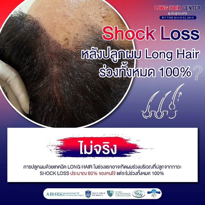 Shock Loss หลังปลูกผม Long Hair ร่วงทั้งหมด 100%?