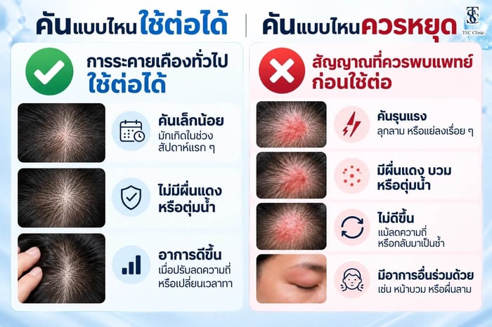 คันแบบไหนใช้ Minoxidil ต่อได้ คันแบบไหนควรหยุด
