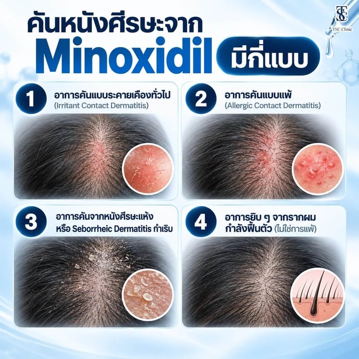 คันหนังศีรษะจาก Minoxidil มีกี่แบบ