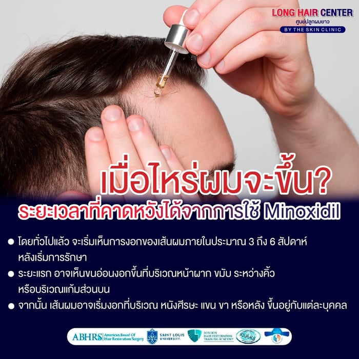 เมื่อไหร่ผมถึงจะขึ้นจากการใช้ Minoxidil?