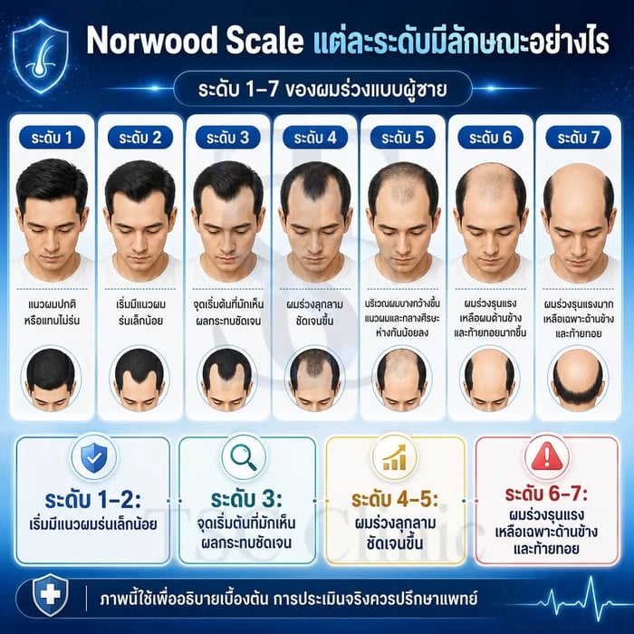 ลักษณะแนวผมแต่ละระดับของ Norwood Scale