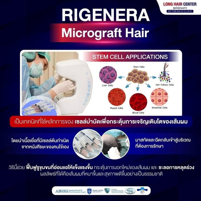Rigenera Micrograft Hair