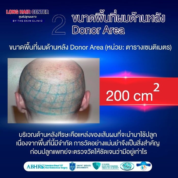ขนาดพื้นที่ผมด้านหลัง (Donor Area)