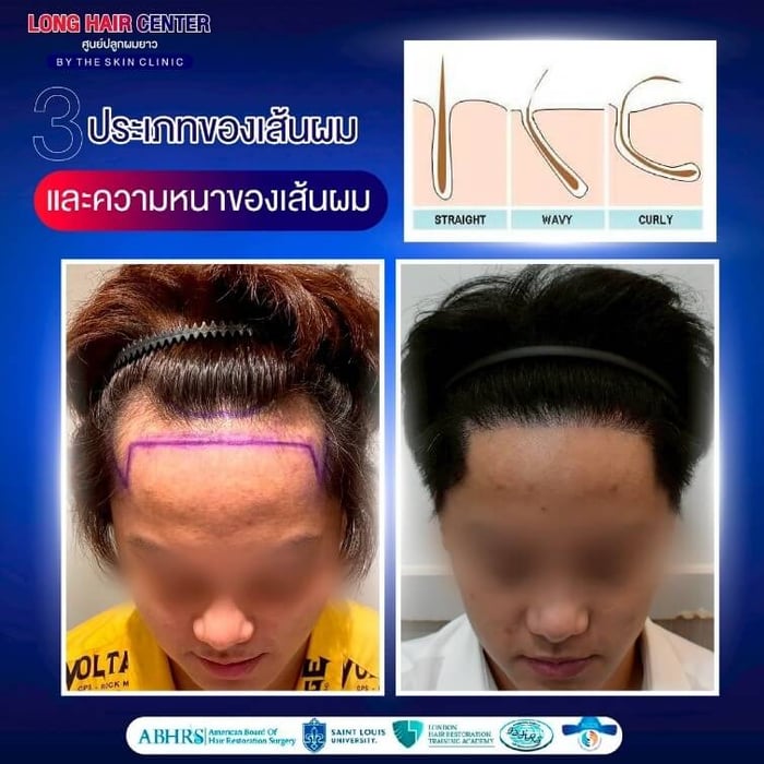 ประเภทของเส้นผมและความหนาของเส้นผม