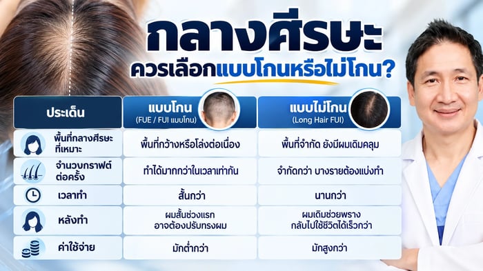 กลางศีรษะควรเลือกแบบโกนหรือไม่โกน