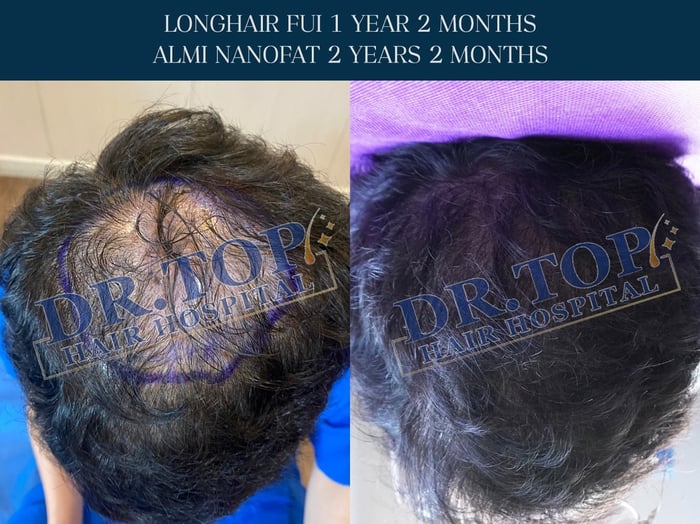 ความสำคัญของการดูแลตัวเองหลังปลูกผม?