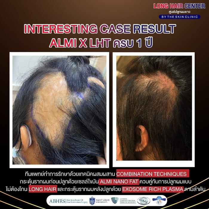 Hair Transplant, คลินิกปลูกผม