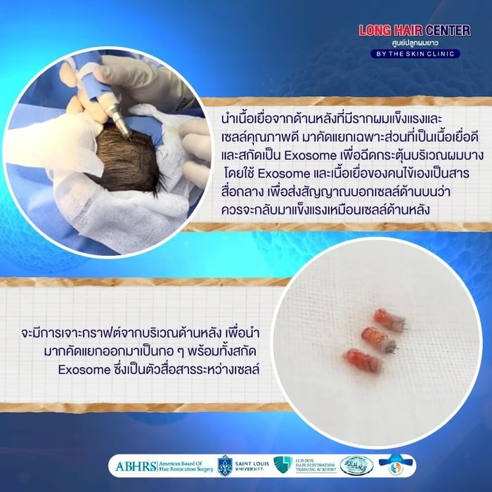 ทำไมต้องใช้เซลล์รากผมจากด้านหลังศีรษะ?